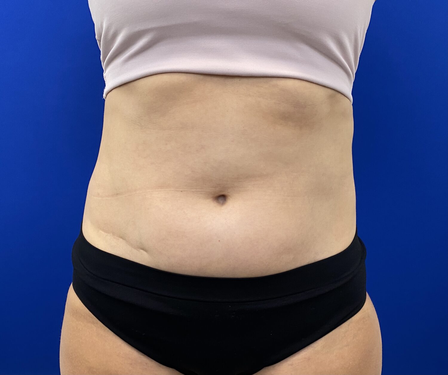 CoolSculpting Experience 