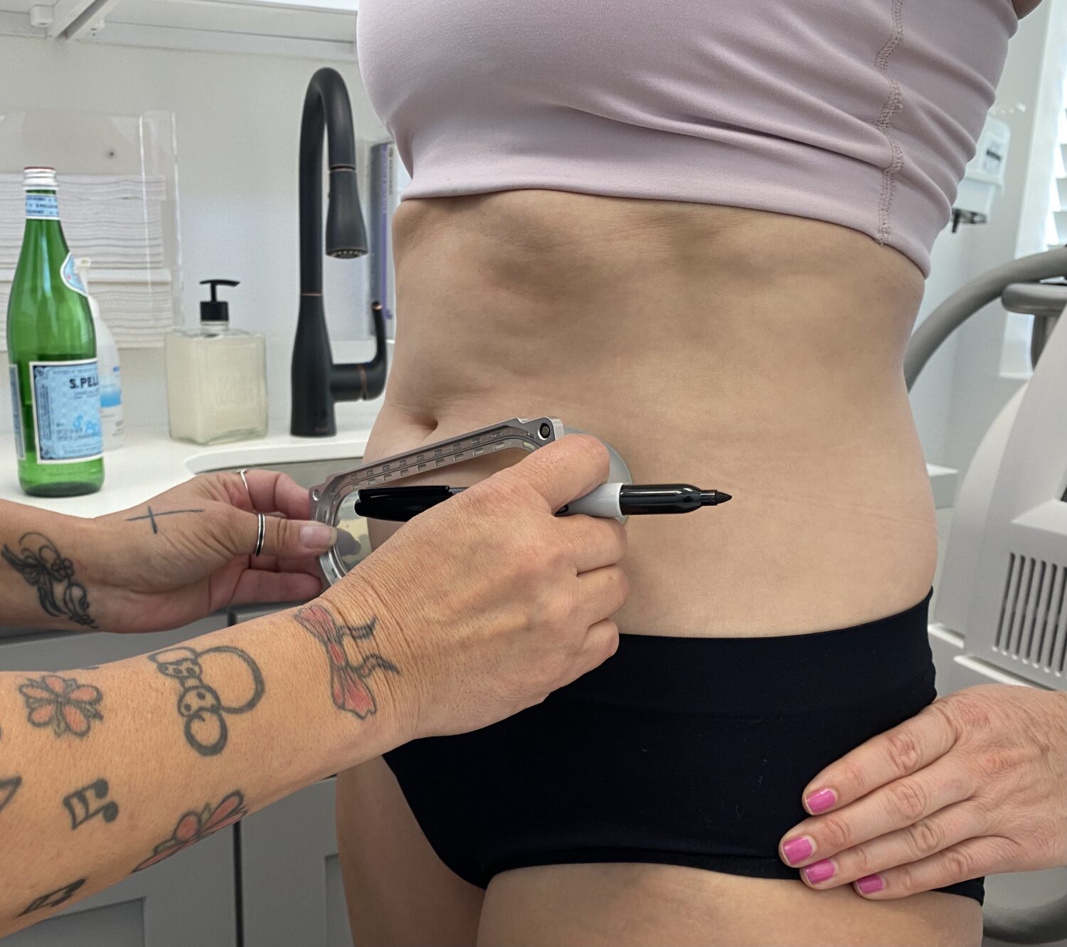 CoolSculpting Experience